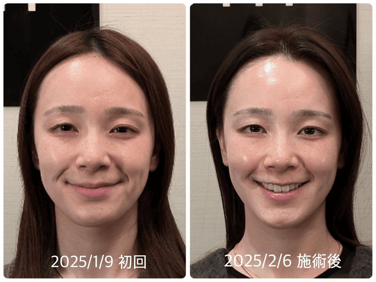 Before/After 2
